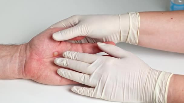 戴医疗手套的女人的手检查一个男人手臂上的烧伤 手掌上灼伤的皮肤 — 图库视频影像