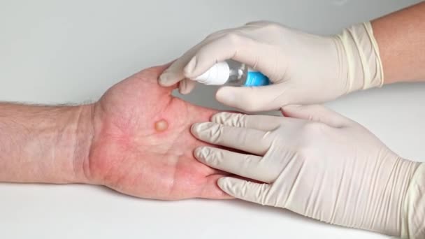 戴医用手套的女人的手用防腐剂治疗男人手上的灼伤 手掌上灼伤的皮肤 — 图库视频影像