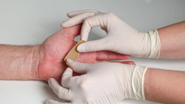 戴医用手套的女人的手在男人手上的热烧伤上涂上医用粘贴石膏 手掌上灼伤的皮肤 — 图库视频影像