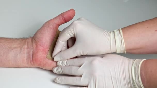 戴医用手套的女人的手从男人手上的热灼伤上取下医用粘贴石膏 手掌上灼伤的皮肤 — 图库视频影像