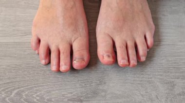 Mantar enfeksiyonu veya hasar görmüş ayak tırnağı, tırnak sağlığıyla ilgili sorunlar, mantar mantarı, hastalıklı ayak tırnaklarını muayene eden doktor.