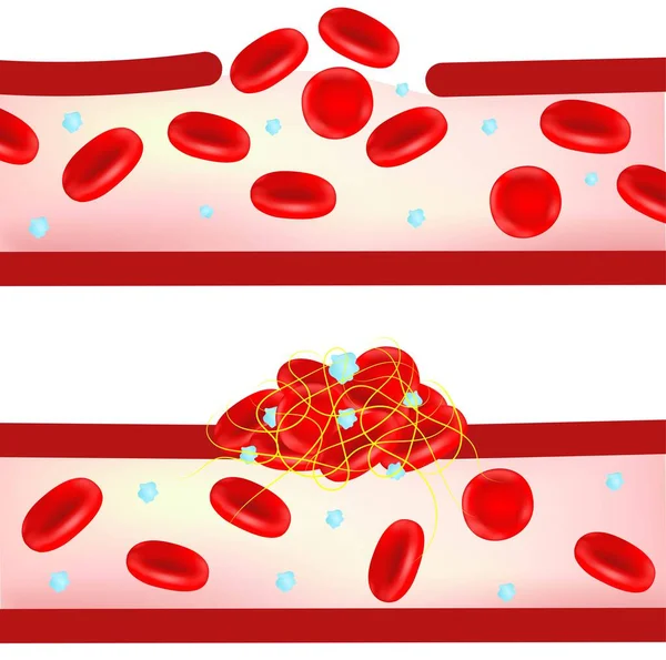 Formación Coágulos Sanguíneos — Vector de stock