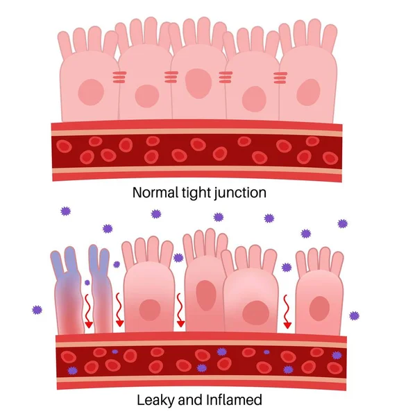 Leaky Gut Syndrome Normal Tight Junction Leaky Inflammation - Stok Vektor