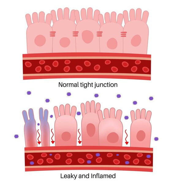 Leaky Gut Syndrome : Normal tight junction, Leaky and Inflammation.