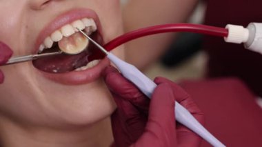 Diş sağlığı, doktor muayenesi, doktor tedavileri. Doktor diş çürüğünü belirlemek için ağız boşluğunu inceliyor, bakterilerin korunması ve tedavinin önemini vurguluyor..