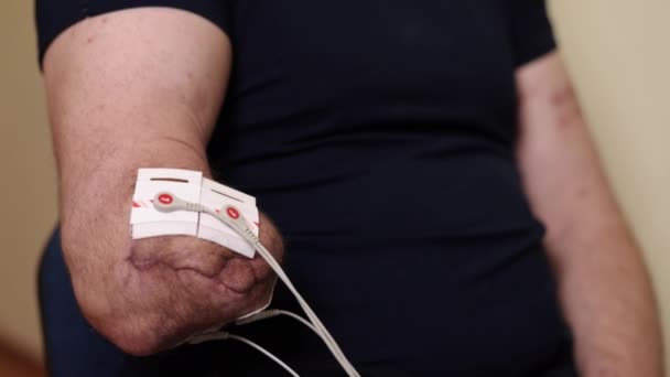 治疗电极 肌肉疗法 康复疗法 在康复过程中 病人的手臂被近距离展示 装有用于非侵入性电疗的电极 — 图库视频影像
