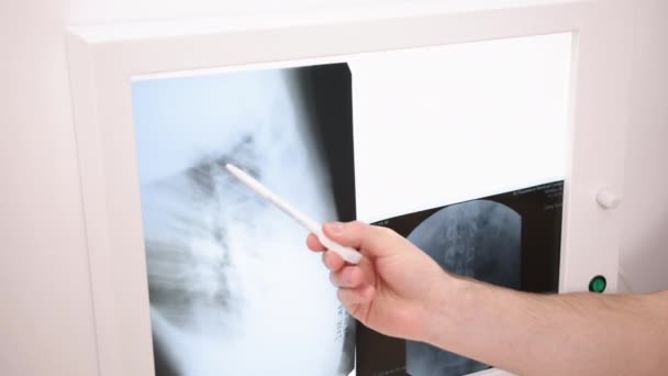 Handgebaar Beeld Detail Radiologie Raadpleging Handgebaren Naar Wervelkolom Röntgenstralen Verlicht — Stockvideo