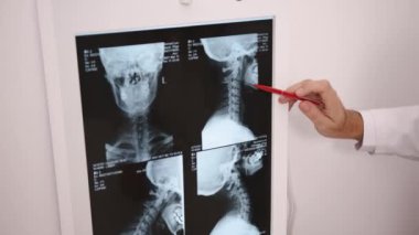 Röntgen Detayları, Tıbbi Görüntüleme, Klinik İnceleme. Doktorlar, ışık kutusunda gösterilen omurga X-ray görüntülerinin belli bölümlerini belirlemek için kırmızı işaret kullanır.