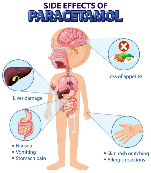 Human Anatomy Diagram Cartoon Style Paracetamol Side Effects Illustration — Archivo Imágenes Vectoriales