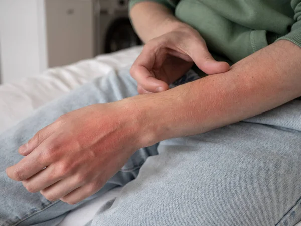 Seorang Pria Menggaruk Tangannya Kulit Merah Yang Rusak Excoriation Neurotic — Stok Foto