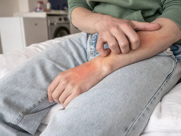 Seorang Pria Menggaruk Tangannya Sampai Merah Gangguan Saraf Dan Konsep — Stok Foto