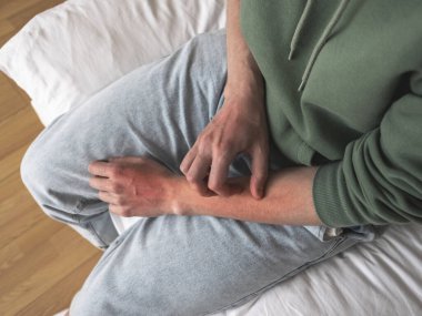 Adamın eli kaşınıyor, kırmızı cilt zarar görmüş. Dezenfekte nevrotik bozukluk, cilt kaşıntısı, duygusal stres veya alerjiler..