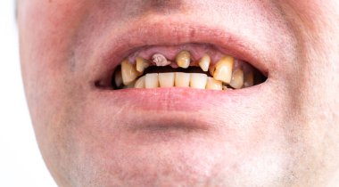 Periodontal hastalık, dişsiz adamın ağzında gevşek dişler, yakın çekim. Hasta için diş sorunları ve ortodontik tedavi.