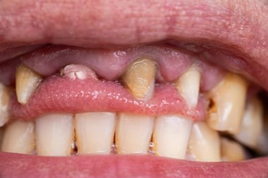 Kırık diş, açık insan ağzında eksik diş makro fotoğrafı. Diş sorunları, diş hekimliği konsepti.