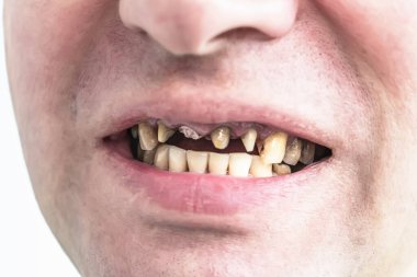 Periodontal hastalık, dişsiz adamın ağzında gevşek dişler, yakın çekim. Hasta için diş sorunları ve ortodontik tedavi.