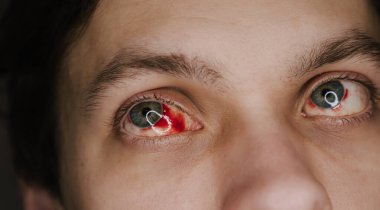 Kanlı insan gözleri, tıbbi durumu ya da yaralanmayı gösteriyor. Ayrıntılı görünüm, sağlık hizmetleri ve tıbbi temalar için uygun ciddiyet ve sağlık etkilerini vurguluyor.
