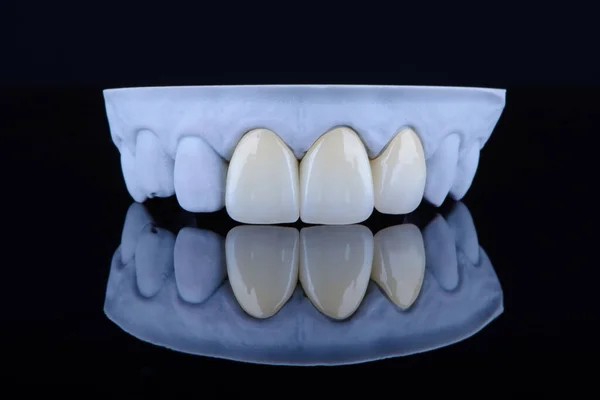 Alta Qualidade Naturalmente Três Coroas Dentárias Únicas Feitas Zircônio Para Fotografias De Stock Royalty-Free