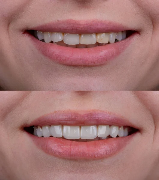 Before and after of smile makeover by dental ceramic veneer, porcelain laminate veneers on front upper teeth. New smile.