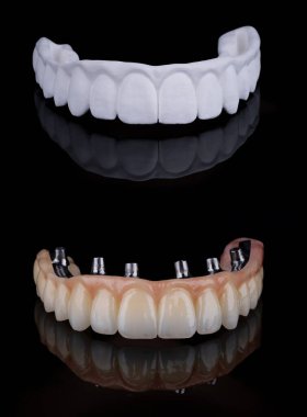 Titanyum çubuk üzerinde tam dişli zirkonyum protezi yapmanın iki aşaması. Zirkonyumu boyadıktan, katmanlaştırmadan ya da boyamadan önce işlenmemiş. Diş sağlığı konsepti.