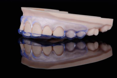 Siyah arkaplan üzerindeki sakız düzeltmesi için 3D saydam diş kalıbı izole edildi. Diş ameliyatı