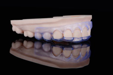 Siyah arkaplan üzerindeki model üzerinde sabitlenmiş sakız düzeltmesi için 3D şeffaf diş şablonu.