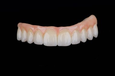 Titanyum çubuk üzerinde tam diş protezi seramik leke ile boyanmış ve yüksek sıcaklıkta pişirilmiş..