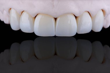 Yüksek kalite doğal olarak zirkonyumdan yapılmış üç diş kaplaması üst çenenin ön dişlerini sabitlemek için. Diş tedavisi.