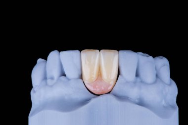 Alt çenenin ön dişlerini sabitlemek için titanyumdan yapılmış zirkonyumdan yapılmış iki diş macunu. Diş tedavisi ve implantasyon.