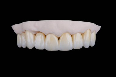 Üst çenenin zirkonyumdan yapılmış kaliteli diş kaplamaları. Üç boyutlu baskı modelinin eski dişleri gibi stilize edilmiş. Diş tedavisi.