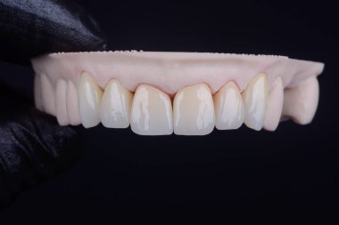 Diş zirkon 'u siyah eldivenle insan elinin üstünde taçlandırılır. Katmanlı ya da boyalı diş taçları seramik için leke kullanılıyor ve yüksek sıcaklıklarda pişiriliyor. Diş sağlığı konsepti.
