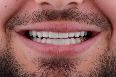 Erkek gülümsemesi, diş seramik kaplaması, porselen kaplamalar. Seramik ultra ince kaplamalı üst ve alt çene protezi.