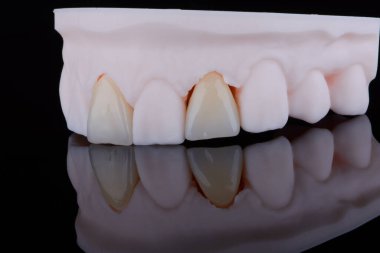 Yüksek kalite, üst çenenin ön dişlerine takmak için zirkonyumdan yapılmış iki dişli kron. Diş tedavisi.