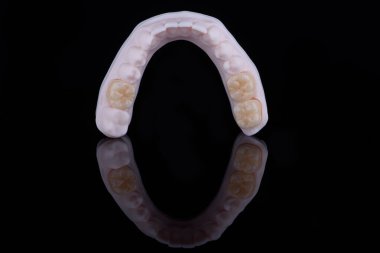 Yüksek kalite doğal olarak alt çenenin dişlerini sabitlemek için çok katmanlı zirkonyumdan yapılmış üç diş kaplaması..