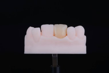 Merkezi maksiller kesici dişin ayna kopyası, çok ince diş seramik kaplaması ya da baskılı modelin kaplaması. Diş tedavisi