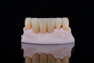 Yüksek kalite doğal olarak zirkonyumdan yapılmış üç diş kaplaması alt çenenin ön dişlerine sabitleme için. Diş tedavisi.