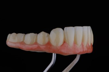 Titanyum çubuk üzerinde tam diş protezi seramik leke ile boyanmış ve yüksek sıcaklıkta pişirilmiş..