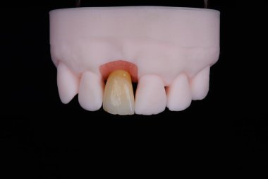 Merkezi üst çene kesici dişinin ayna kopyası, baskılı modele sabitlenmiş titanyum ayağının zirkon tacı. Diş tedavisi