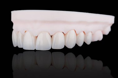 Üst çeneli kaliteli dişli zirkonyum kaplama. Üç boyutlu baskı modelinde genç dişler olarak stilize edilmiş. Diş tedavisi.