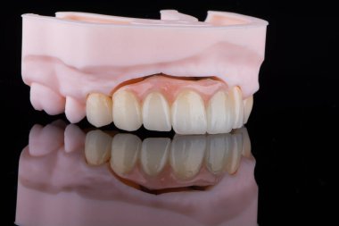 Doğal olarak, ön dişlere ve titanyum implantlara sabitleme için zirkonyumdan yapılmış yapay sakızla dişler ve monolitik köprü..