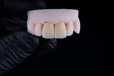 Yüksek kalite doğal olarak zirkonyumdan yapılmış üç diş kaplaması üst çenenin ön dişlerini sabitlemek için. Diş tedavisi.