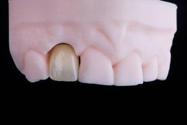 Zirkonyumdan yapılmış üst çene kesici dişler, baskılı modelde aşırı ince diş seramik kaplaması ya da taç. Diş tedavisi