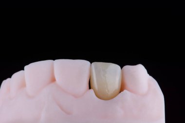 Zirkonyumdan yapılmış üst çene kesici dişler, baskılı modelde aşırı ince diş seramik kaplaması ya da taç. Diş tedavisi