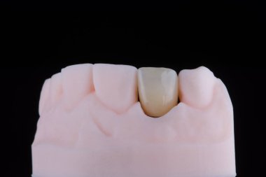 Zirkonyumdan yapılmış üst çene kesici dişler, baskılı modelde aşırı ince diş seramik kaplaması ya da taç. Diş tedavisi