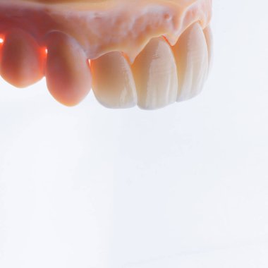 Yüksek kalite doğal olarak üst çenenin ön dişlerine takmak için zirkonyumdan yapılmış dört dişli kron. Diş tedavisi. Beyaz arkaplan.