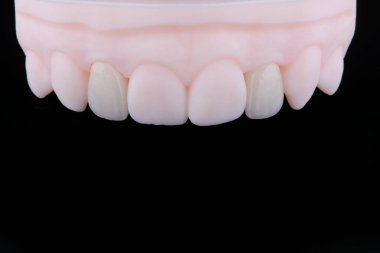 Yüksek kalite doğal olarak zirkonyumdan yapılmış üç diş kaplaması üst çenenin ön dişlerini sabitlemek için. Diş tedavisi.