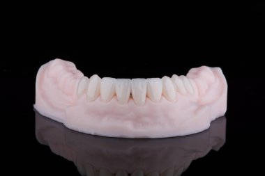 Alt çene kaplamalı kaliteli dişli zirkonyum kaplamalar. Üç boyutlu baskılı model üzerinde genç parlak dişler olarak stilize edilmiş. Diş tedavisi.