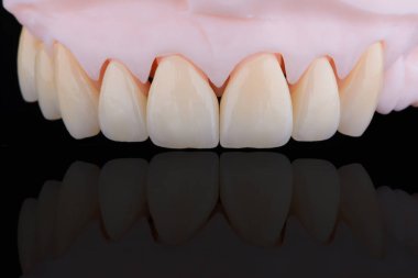 Yüksek kalite, üst çenenin ön dişlerine takmak için zirkonyumdan yapılmış sekiz dişli kron. Diş tedavisi.