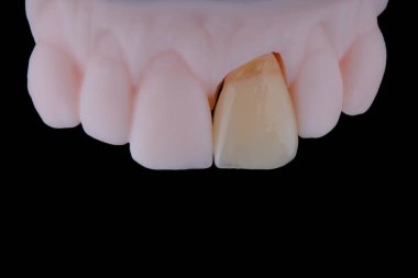 Merkezi maksiller kesici dişin ayna kopyası, çok ince diş seramik kaplaması ya da baskılı modelin kaplaması. Diş tedavisi