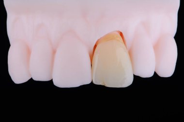 Merkezi maksiller kesici dişin ayna kopyası, çok ince diş seramik kaplaması ya da baskılı modelin kaplaması. Diş tedavisi