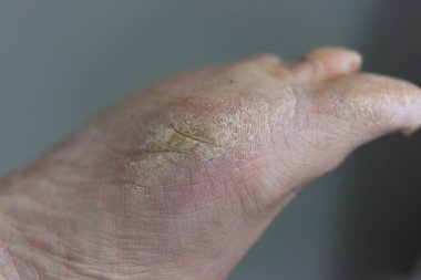 Yaya olarak kurumuş, çatlamış deriyi kapatın.